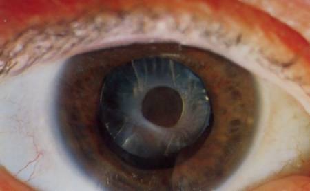 Anterior capsular opacification