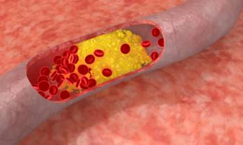 Atherosclerosis Plaque