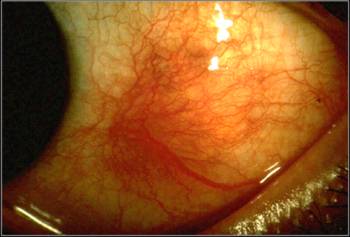 Scleritis