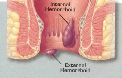 Haemorrhoids