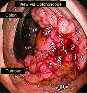 Colon Cancer