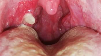 Tonsil stones causing bad breath