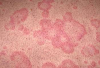 Urticaria (Hives)