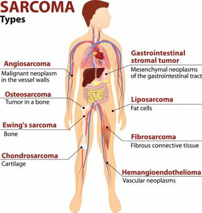 Sarcoma - a complex and agressive cancer