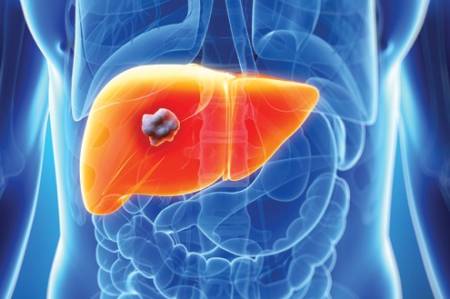 Liver cancer